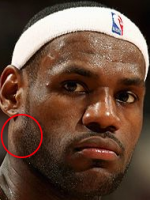 Lebron James underwent surgery at Cleveland Clinic