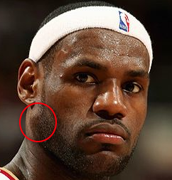 Lebron James benign growth along his right jaw line